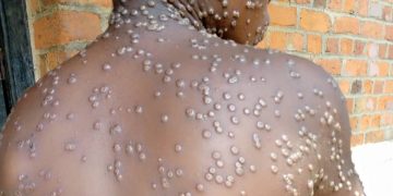 Société -Gabon/Santé: Épidémie de la Variole du singe, 20 cas suspects, 2 confirmés 0 décès.
