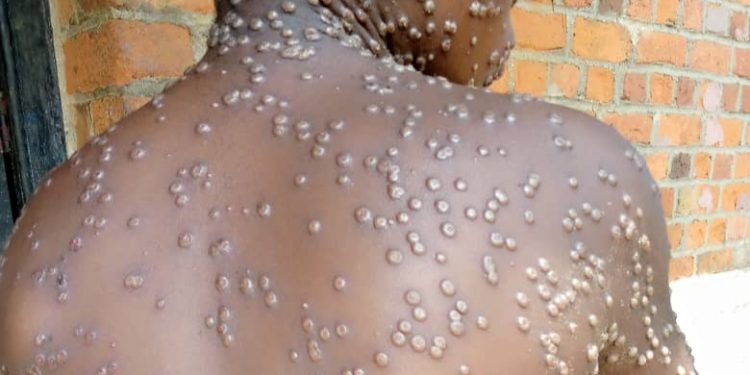 Société -Gabon/Santé: Épidémie de la Variole du singe, 20 cas suspects, 2 confirmés 0 décès.